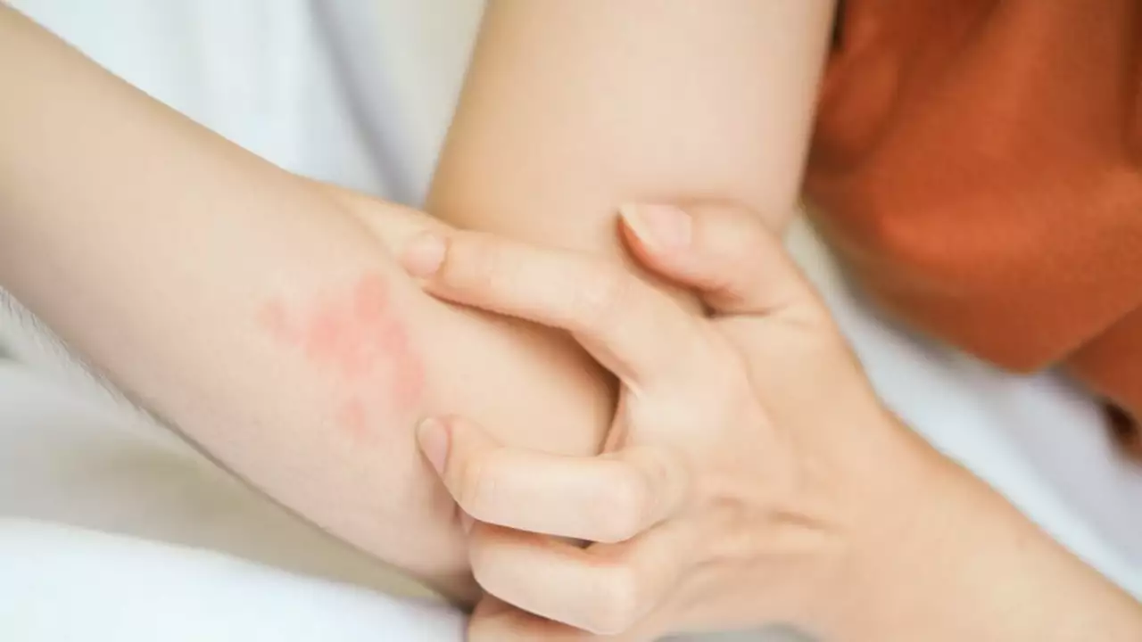 Anal itching and irritation from insect bites: a global health concern