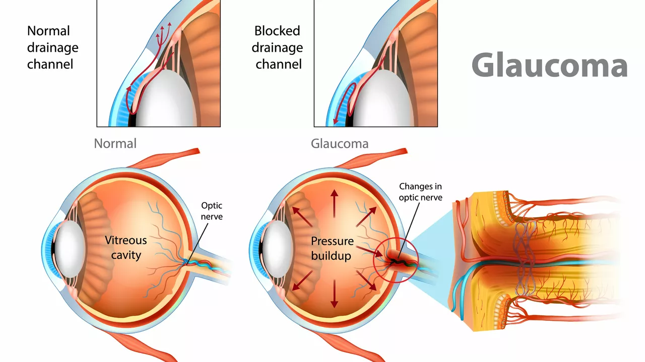 Open-Angle Glaucoma: A Comprehensive Guide to Living with This Eye Condition